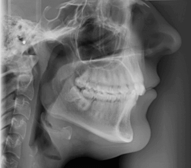 CEPH X-ray CEPH X-ray