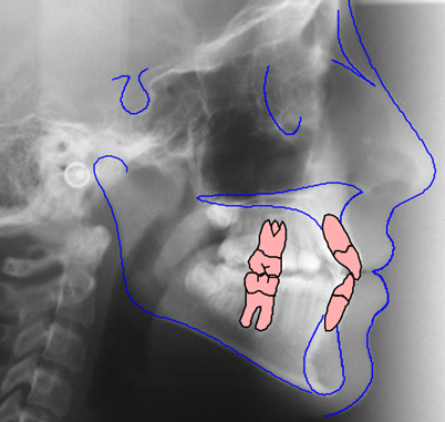ცეფალომეტრიული CEPH ტრასირება CT DENT cephalometric-ceph-tracing-ctdent