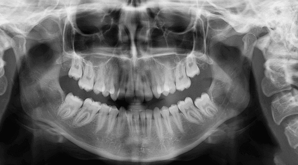 OPG X-Ray OPG X-Ray
